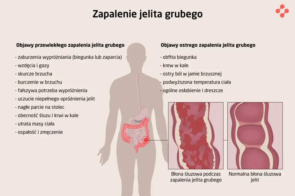 Zapalenie jelit objawy: biegunka, zaparcia, wzdęcia, bóle brzucha, krew w kale, gorączka, osłabienie. Ilustracja pokazuje zmiany w błonie śluzowej jelita.