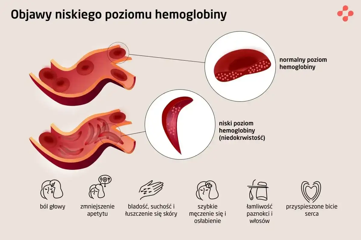 Niska hemoglobina w morfologii - normy i przyczyny