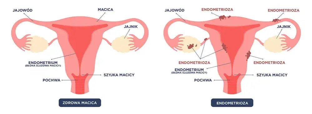 Zdjęcie Jakie leki na endometriozę? Poznaj skuteczne metody łagodzenia bólu