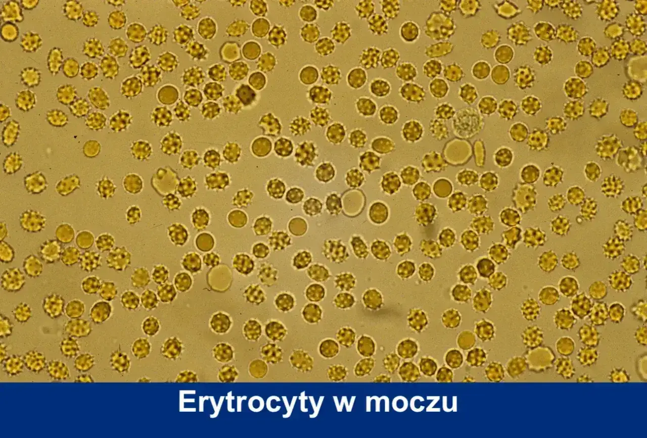 Mikroskopowy obraz ukazujący liczne erytrocyty w moczu, niektóre o zmienionym kształcie, wskazujące na obecność krwi w próbce.