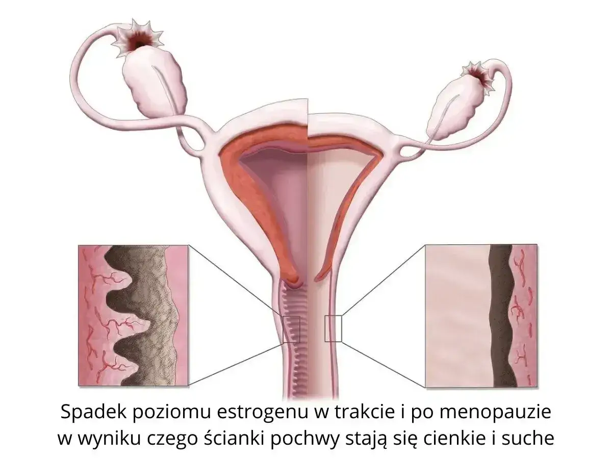 Ilustracja pokazuje, jak spadek estrogenu prowadzi do atrofii pochwy, powodując ścieńczenie i suchość jej ścianek.