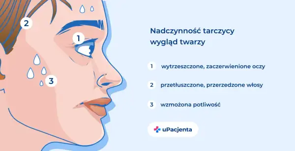 Nadczynność tarczycy objawy: wytrzeszczone oczy (1), przetłuszczone włosy (2), wzmożona potliwość (3).
