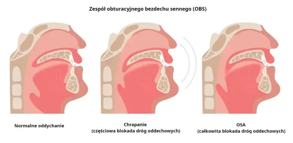 Ilustracja pokazuje przekrój dróg oddechowych przy normalnym oddychaniu, chrapaniu (częściowa blokada) i bezdechu sennym (całkowita blokada).
