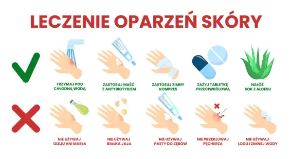 Ilustracja pokazuje leczenie oparzeń skóry: chłodna woda, maść z antybiotykiem, zimny kompres, tabletki przeciwbólowe, sok z aloesu. Unikaj masła, jajka, pasty do zębów, lodu.