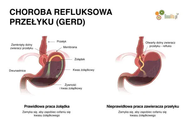 Ilustracja pokazuje prawidłowe i nieprawidłowe działanie zwieracza przełyku, wyjaśniając refluks i jego objawy.