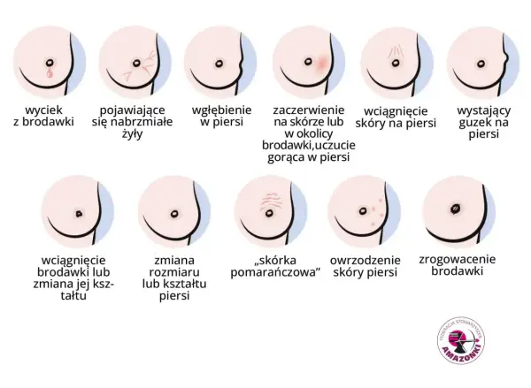 Ilustracja pokazuje różne zmiany w piersiach, w tym wyciek z brodawki, zaczerwienienie, wgłębienie, guzek, zmiany skórne i zrogowacenie. Ważne jest, by zwracać uwagę na sutki.