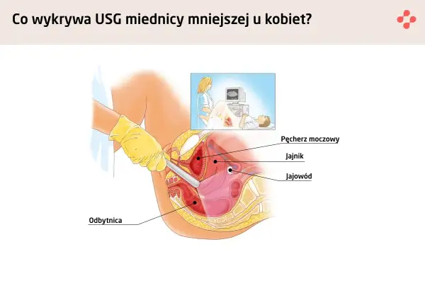 Ilustracja przedstawia badanie usg transwaginalne, pokazując narządy miednicy mniejszej: pęcherz moczowy, jajnik, jajowód i odbytnicę.