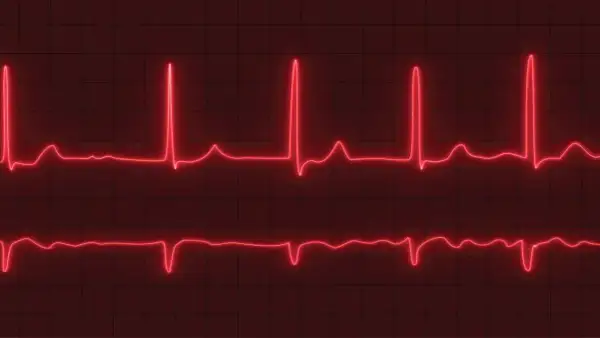 Dwa zapisy EKG na czerwonym tle. Górny zapis pokazuje szybkie, regularne skoki, sugerujące tachykardię zatokową. Dolny zapis jest wolniejszy.