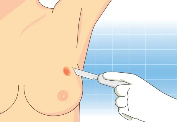 Ilustracja przedstawia biopsję gruboigłową piersi. Dłoń w rękawiczce trzyma skalpel, zbliżając się do podejrzanej zmiany na piersi.