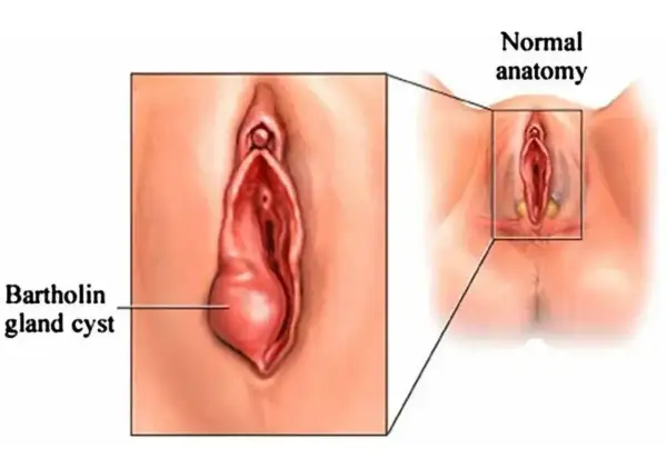 Ilustracja pokazuje powiększony gruczoł Bartholina z torbielą, w porównaniu do normalnej anatomii.