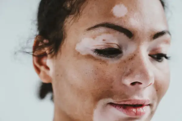 Portret kobiety z widocznym **vitiligo** na twarzy. Jasne plamy kontrastują z jej ciemniejszą skórą, tworząc unikalny wzór.